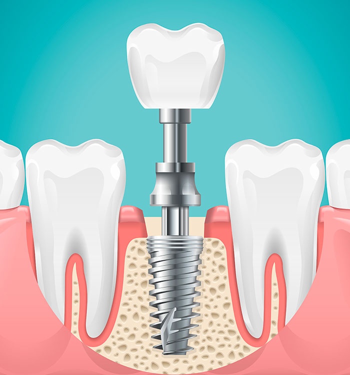 Implant dentaire Chartres
